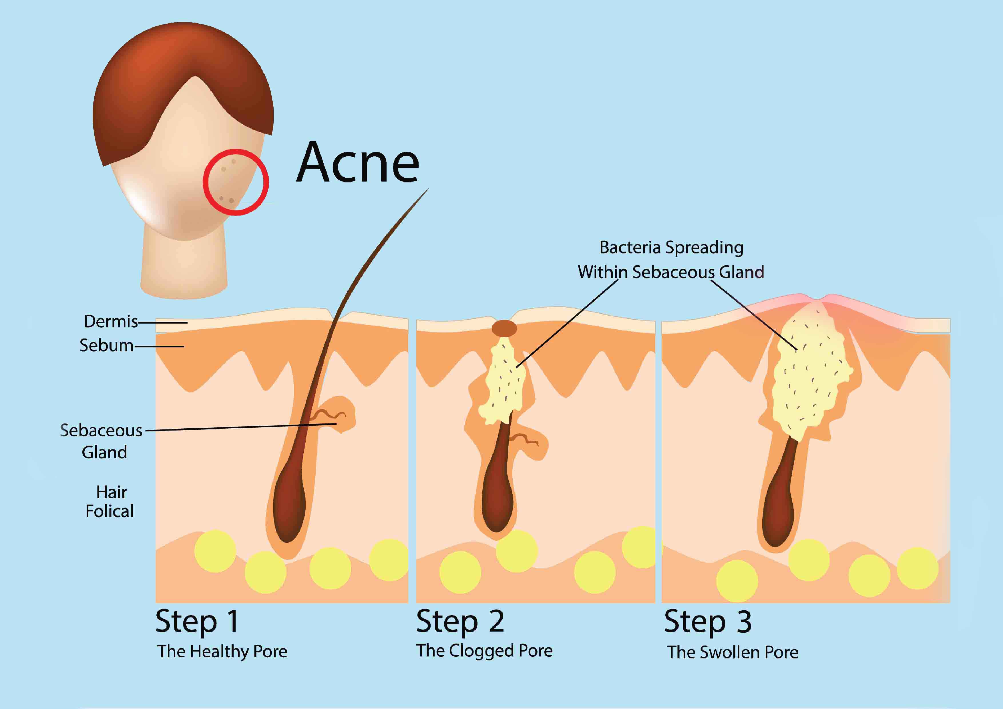 Bagaimana Jerawat Dapat Terjadi ?