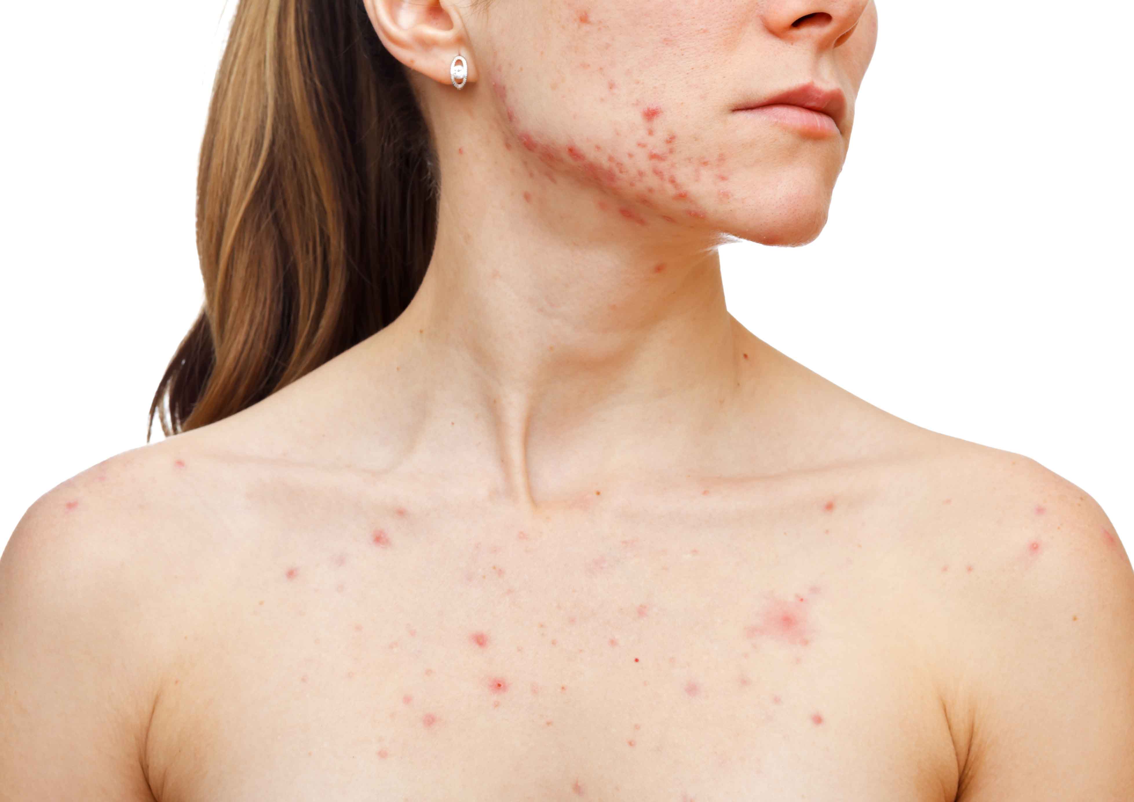 Acne Vulgaris