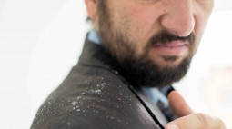 Ketombe ( Dandruff )