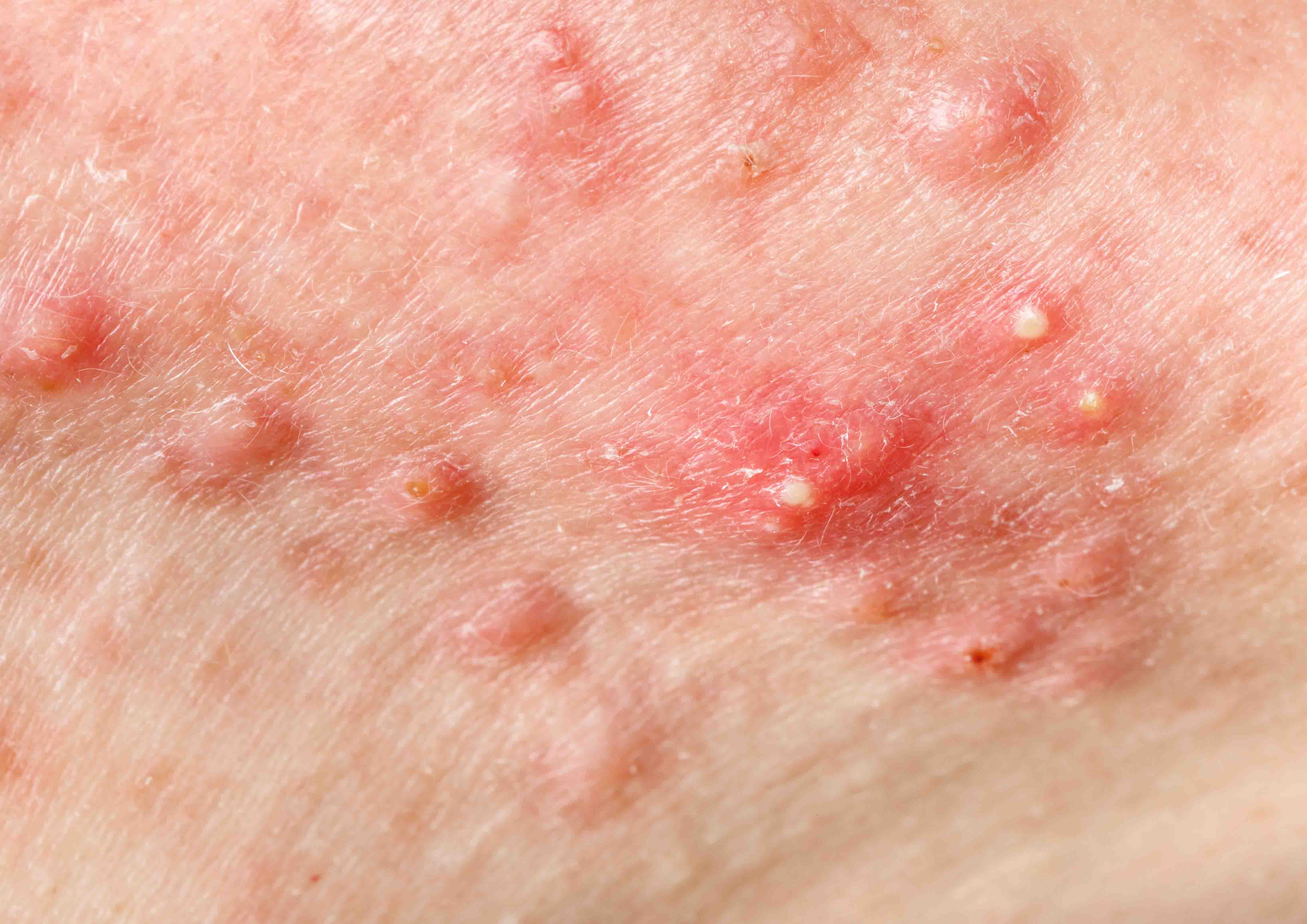 Cara Cepat Menghilangkan Jerawat Batu Dan Bekasnya