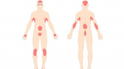 Psoriasis, Penebalan Kulit yang Membuat Malu.