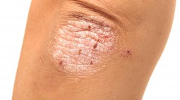 Penyebab dan Perawatan Psoriasis